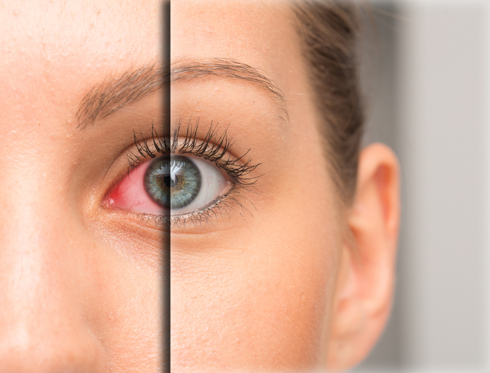 Red,Eye,Before,And,After,Eyedrop,Treatment