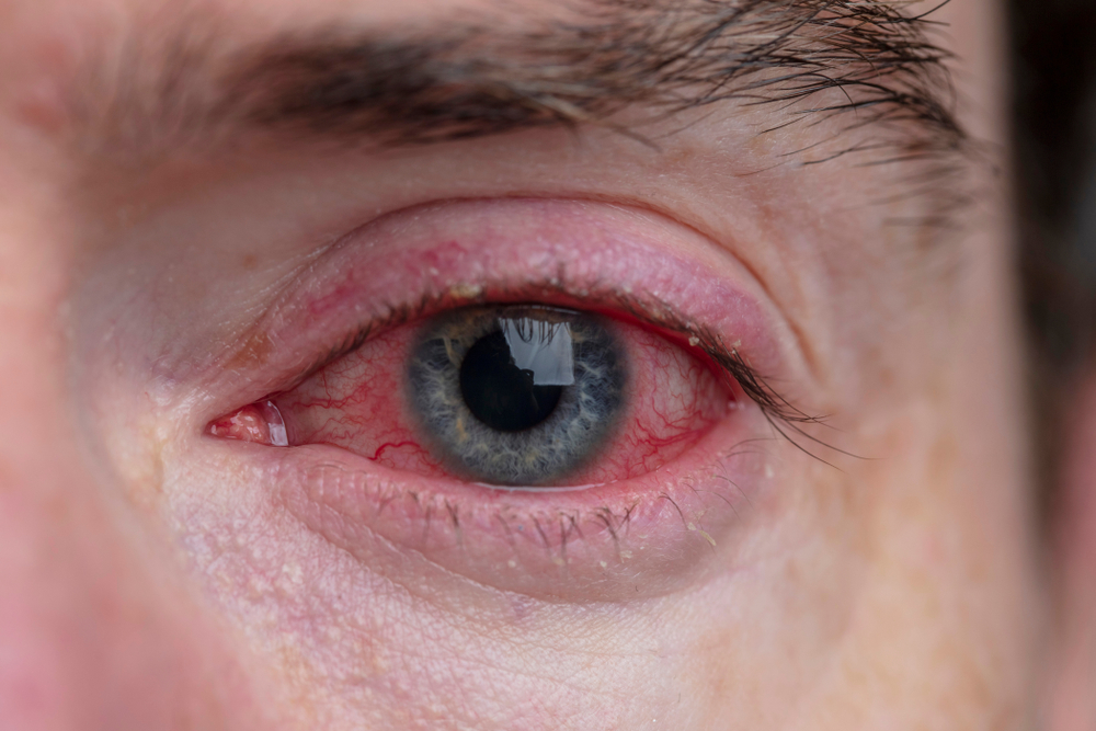 Close,Up,Of,A,Severe,Bloodshot,Eye.,Blepharitis,,Conjunctivitis,Condition