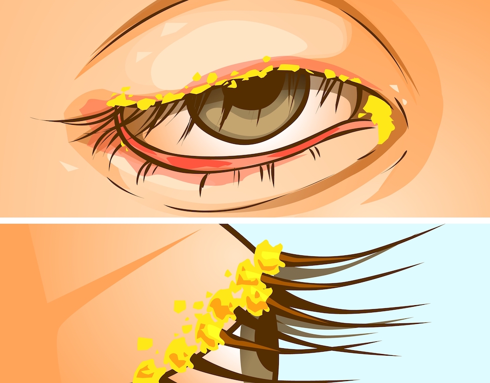 Closeup,Image,Of,The,Disease,Of,The,Eye.,Blepharitis.,Inflammation