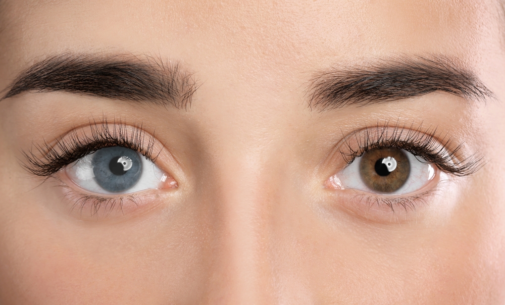 Woman,With,Different,Colors,Of,Eyes,,Closeup.,Heterochromia,Iridis