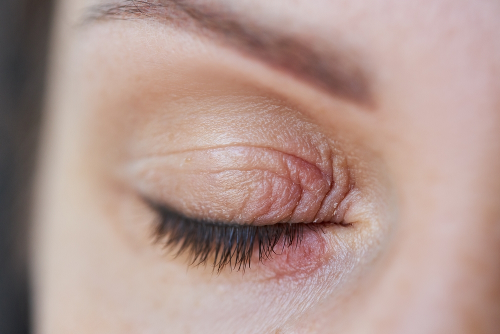 Peeling,And,Swelling,On,The,Eyelid,Of,The,Human,Eye