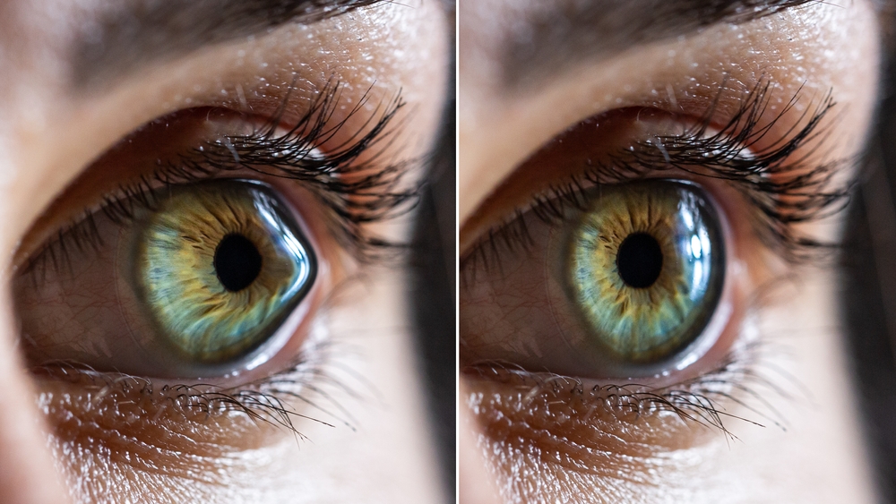 Macro,Before,And,After,Surgery,Of,A,Clear,Female,Eye