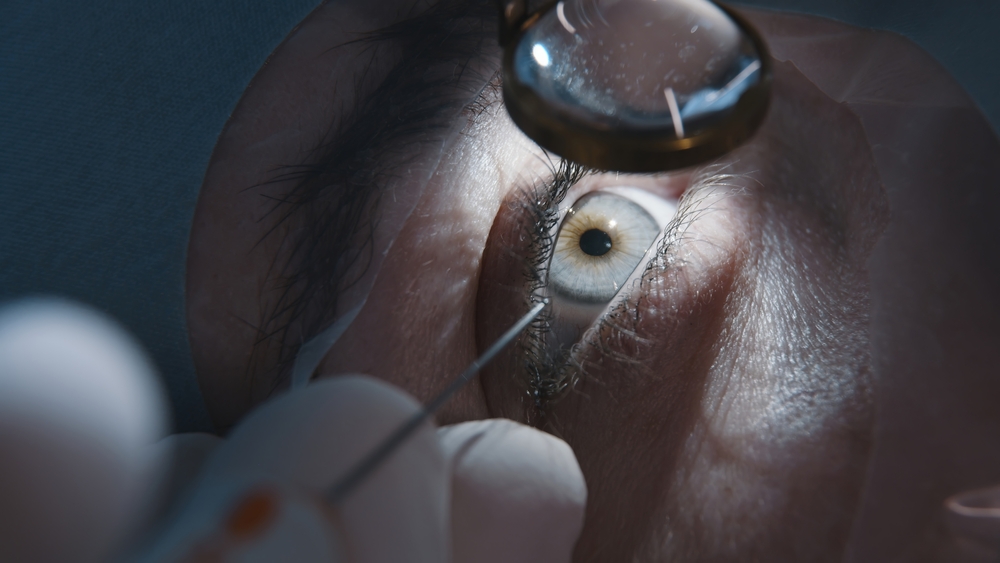 Open,Eye.,Patient,Under,Sterile,Cover.,Close-up.,Laser,Vision,Correction.