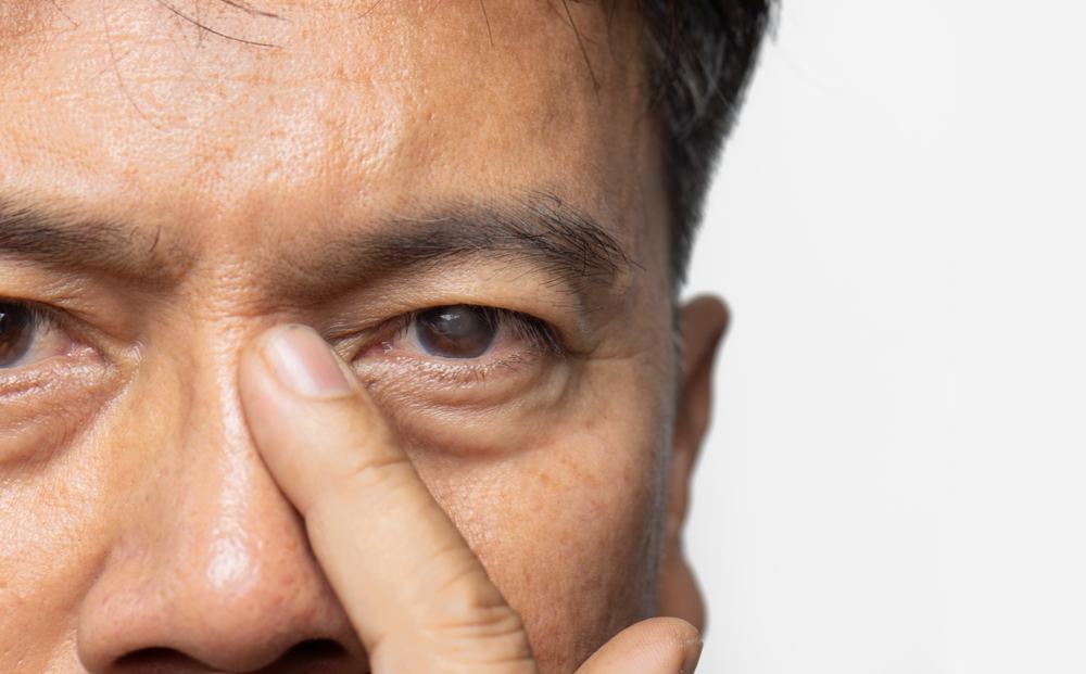 Senior,Man,Has,Cataracts.,Generally,,Cataracts,Are,Common,In,Old