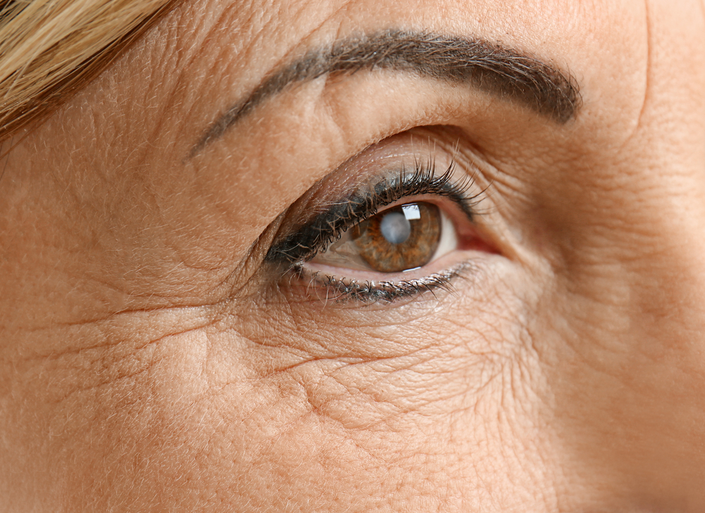 Cataract,Concept.,Senior,Woman's,Eye,,Closeup