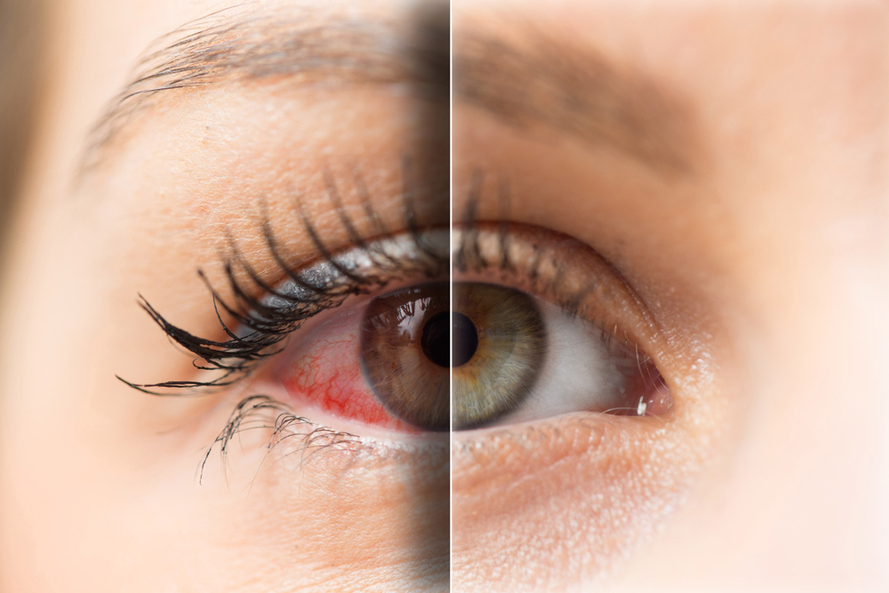 Woman,Red,Eye,Before,And,After,Treatment