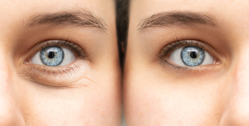 Before,And,After,View,Of,Blepharoplasty,Surgery,,Plastic,Surgery