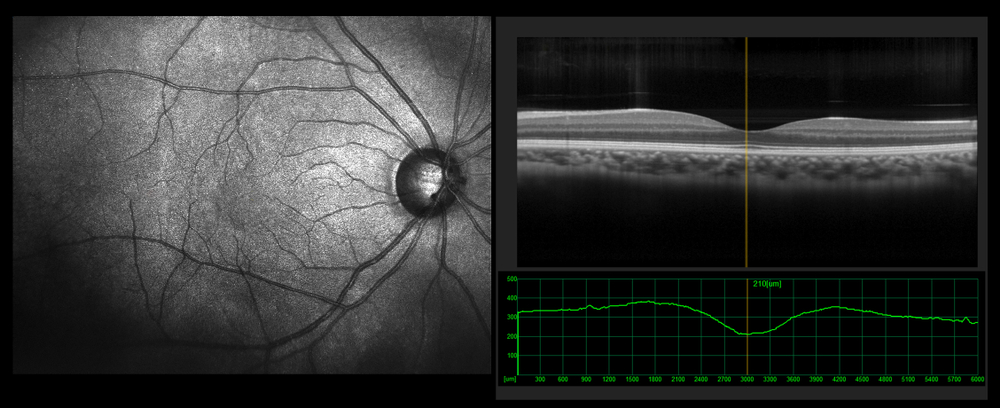 Ophthalmic,Test,-,Oct,Optical,Coherence,Tomography,Measurement.,Slo,Scan