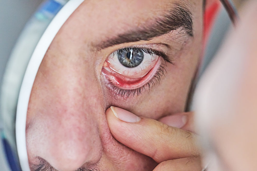 Closeup,Of,Human,Eye,That,Is,Red,And,Irritated.,Symptom