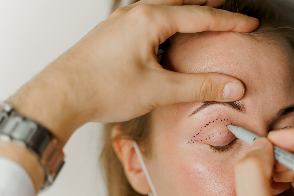 Blepharoplasty,Markup,Close-up,On,The,Face,Before,The,Plastic,Surgery