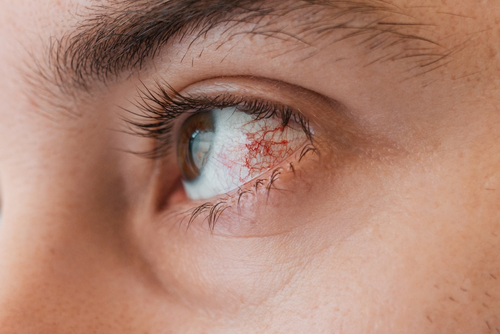 Ophthalmology.,Human,Eye,Close-up,With,Red,Vascular,Mesh,And,Inflammation