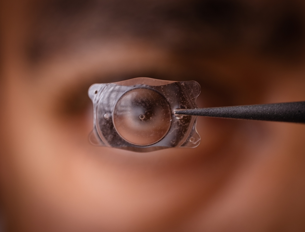 Photo,Of,Implantable,Collamer,Lens,Icl,For,Treating,Refractive,Errors,