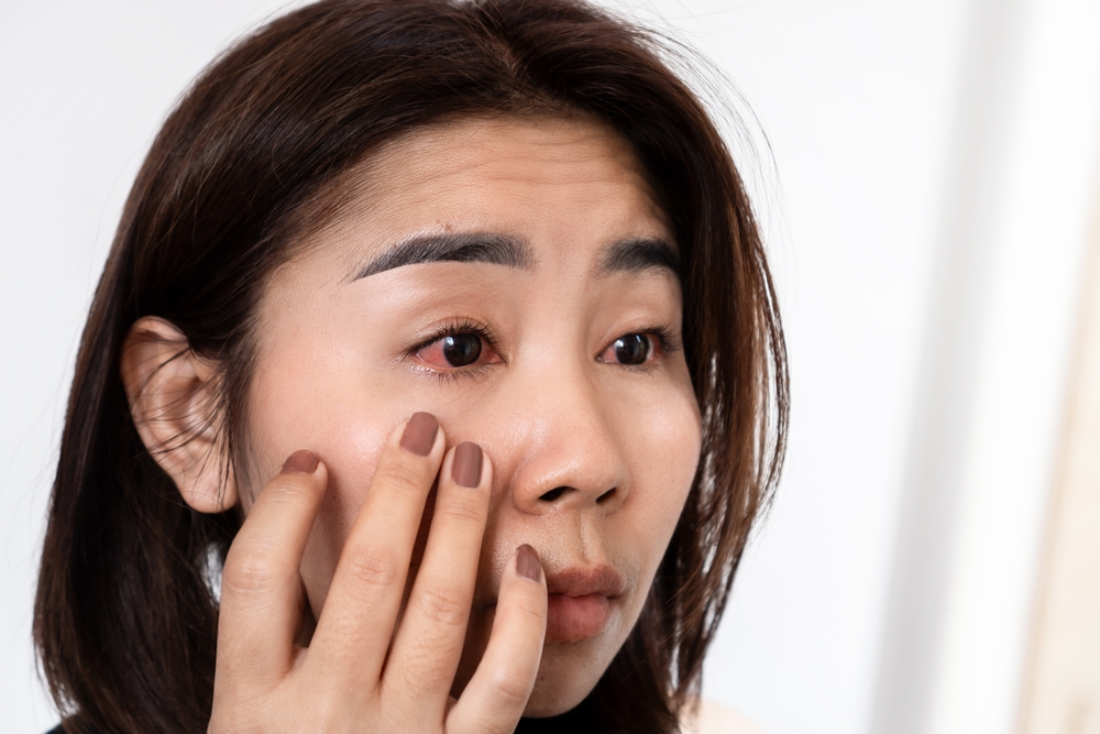 Asian,Woman,Suffering,From,Eye,Inflammation,Feeling,Pain,,redness,And