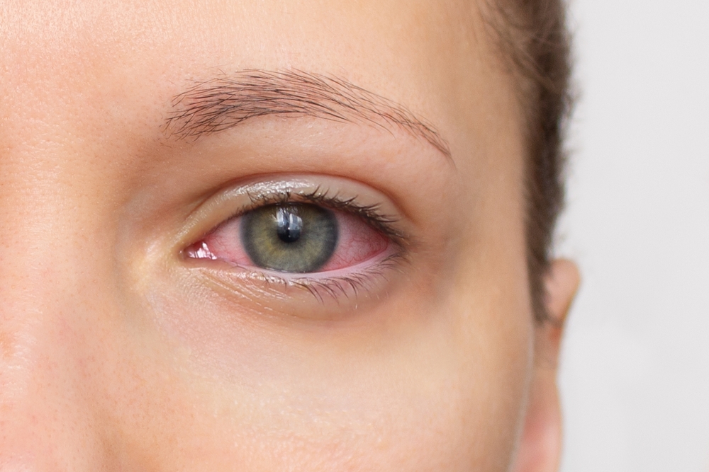 Close,Up,Of,Woman,Face,With,Red,Eye.,Swollen,Eyelids,